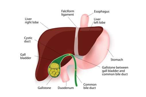 بهبود سنگ صفرا